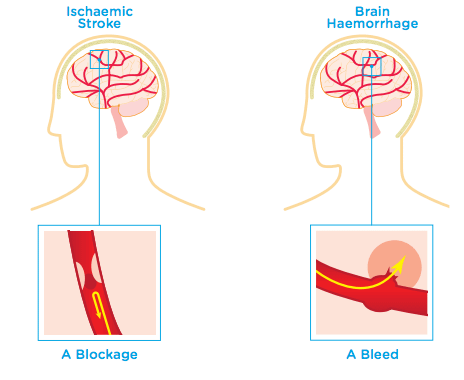 Types of brain injury: stroke and haemorrhage
